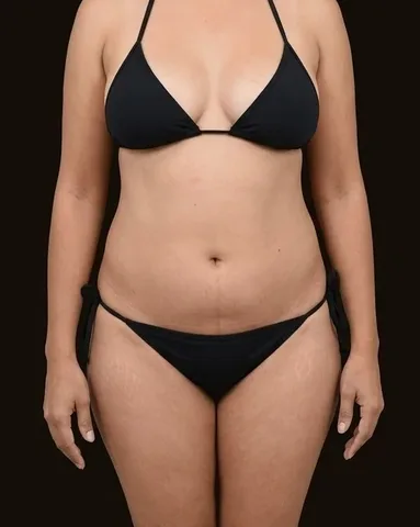 Antes de Lipoescultura, paciente del Dr. Edgar Achá Vargas
