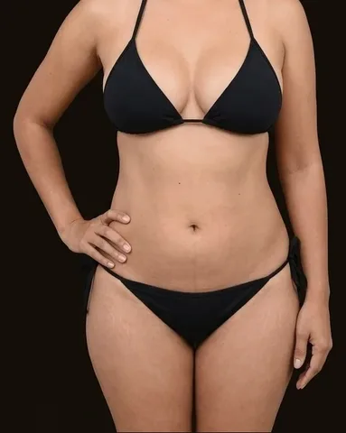 Después de Lipoescultura, paciente del Dr. Edgar Achá Vargas