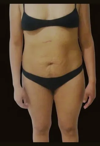 Antes de Lipoescultura + Abdominoplastia + Mamoplastia de Aumento, paciente del Dr. Edgar Achá Vargas