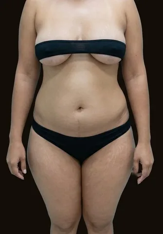 Antes de Lipoescultura + Abdominoplastia + Mastopexia, paciente del Dr. Edgar Achá Vargas