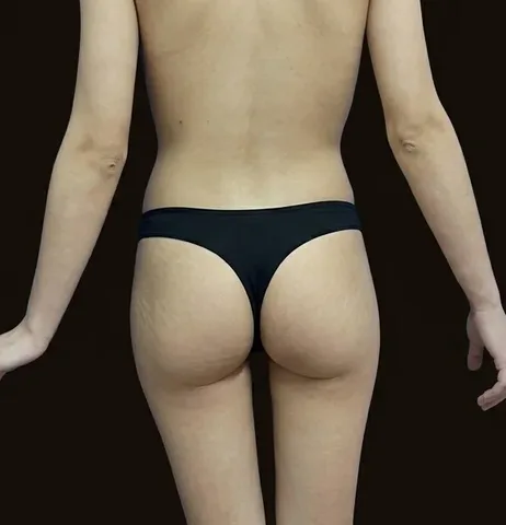 Antes de Gluteoplastia con Prótesis, paciente del Dr. Edgar Achá Vargas