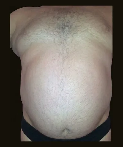 Antes de Lipoescultura, paciente del Dr. Edgar Achá Vargas