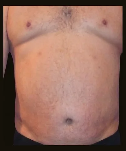 Después de Lipoescultura, paciente del Dr. Edgar Achá Vargas