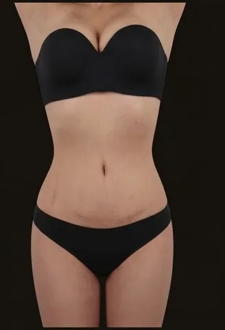 Después de Lipoescultura + Abdominoplastia, paciente del Dr. Edgar Achá Vargas