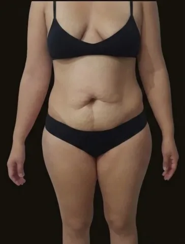 Antes de Lipoescultura + Abdominoplastia, paciente del Dr. Edgar Achá Vargas
