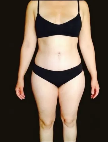 Después de Lipoescultura + Abdominoplastia, paciente del Dr. Edgar Achá Vargas