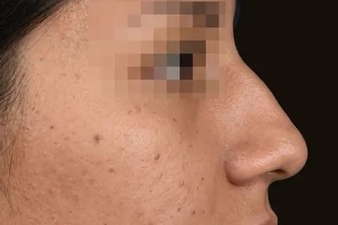 Antes de Rinoplastia, paciente del Dr. Edgar Achá Vargas