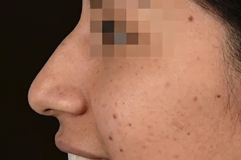 Antes de Rinoplastia, paciente del Dr. Edgar Achá Vargas