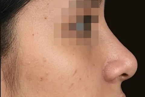 Después de Rinoplastia, paciente del Dr. Edgar Achá Vargas