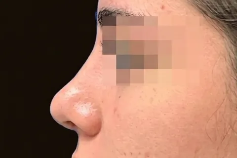 Después de Rinoplastia, paciente del Dr. Edgar Achá Vargas