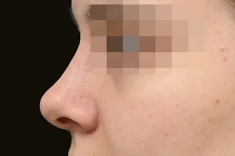 Después de Rinoplastia, paciente del Dr. Edgar Achá Vargas