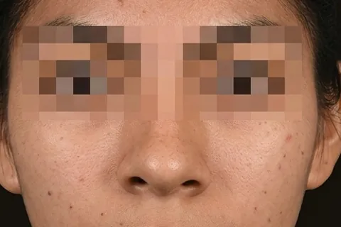 Después de Rinoplastia, paciente del Dr. Edgar Achá Vargas