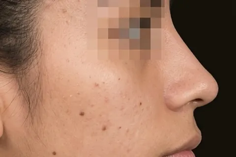 Después de Rinoplastia, paciente del Dr. Edgar Achá Vargas
