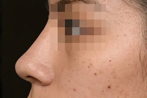 Después de Rinoplastia, paciente del Dr. Edgar Achá Vargas