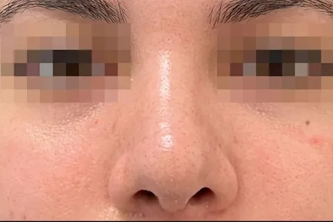 Después de Rinoplastia, paciente del Dr. Edgar Achá Vargas
