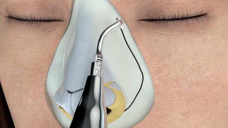 En este momento estás viendo Rinoplastia ultrasónica, la innovadora técnica que multiplicó los retoques de nariz