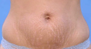 Lee más sobre el artículo ¿La abdominoplastia elimina las estrías?