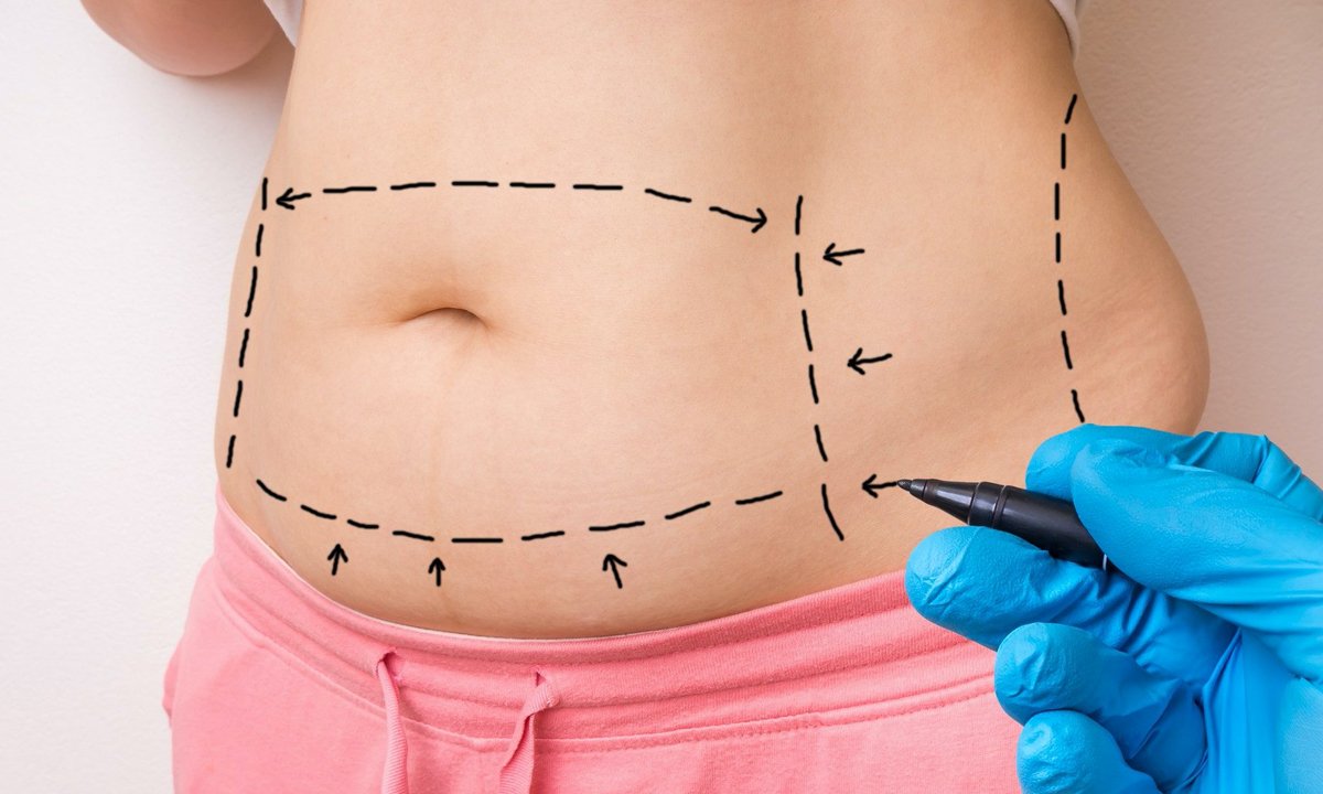 Lee más sobre el artículo ¿Realizarme una abdominoplastia puede afectar a un futuro embarazo?