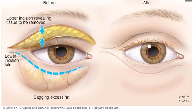 blefaroplastia