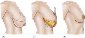 mamoplastia